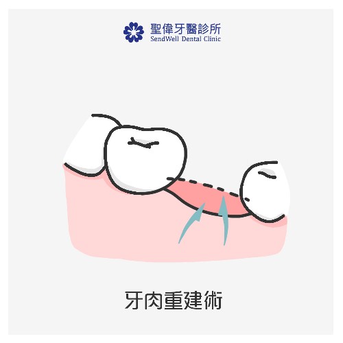 牙肉重建術