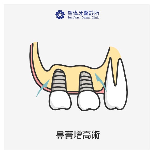 智齒的介紹與影響